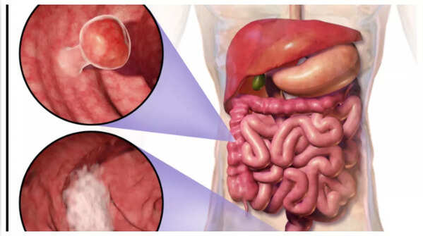 Image depicting blood in stool.